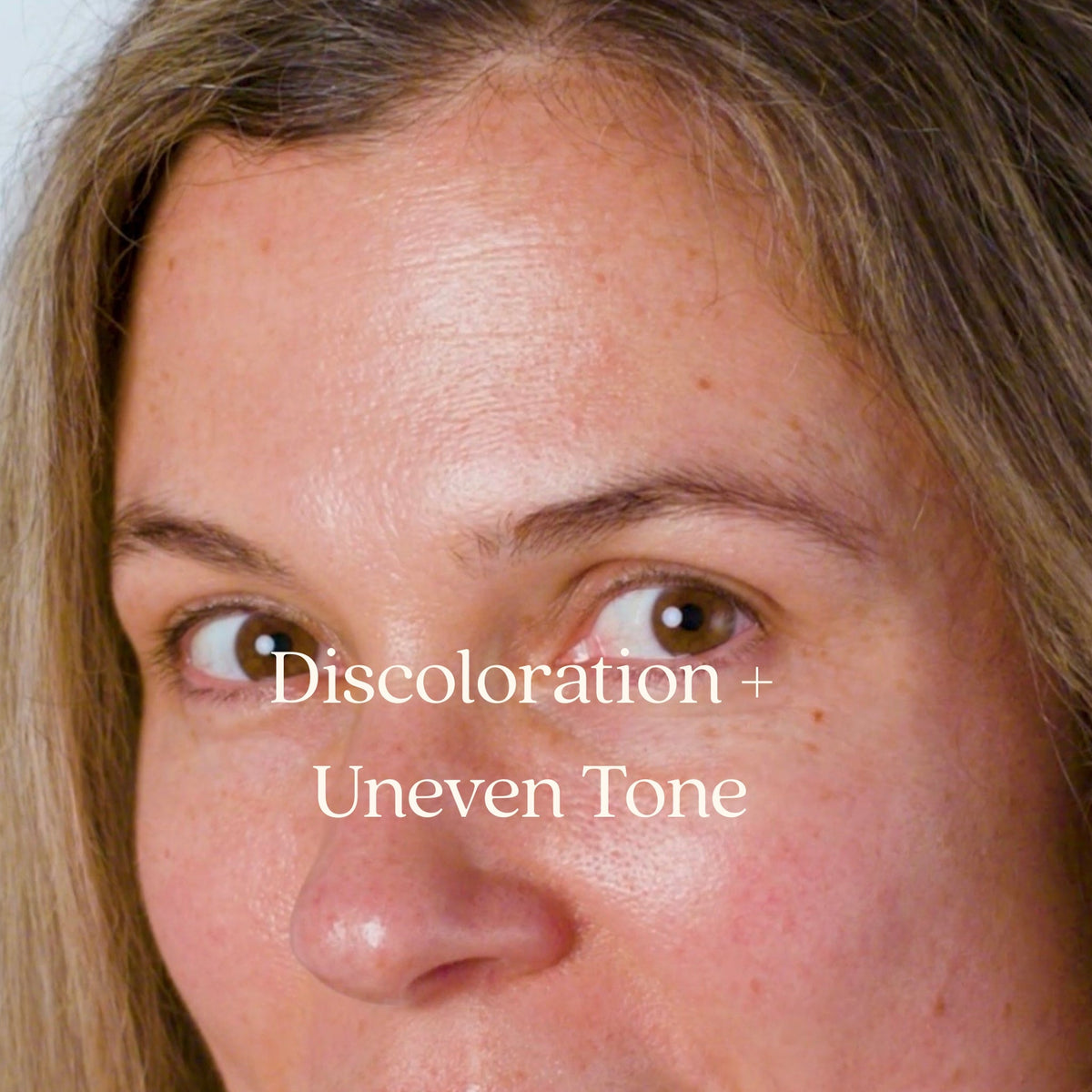 Discoloration + Uneven Tone