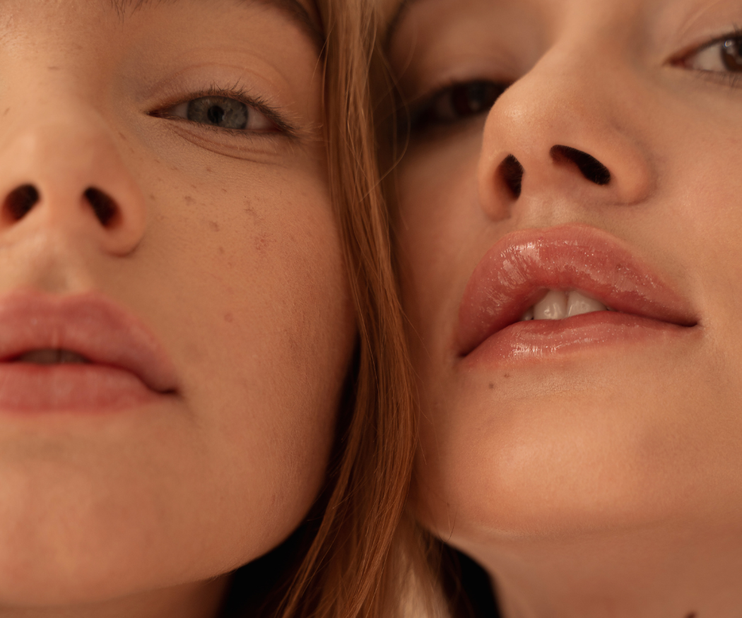 acne