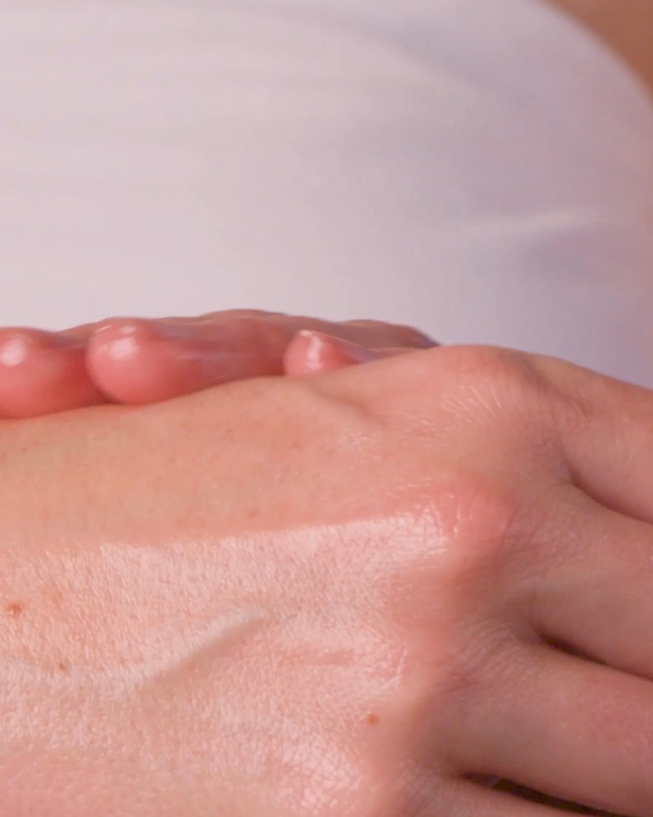 Eczema